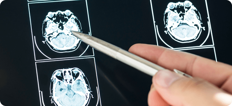 Remote Monitoring in Septic Encephalopathy